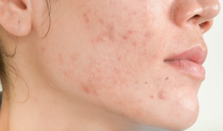 Dermatologist recommends a skincare regimen to address persistent acne