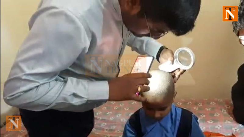 Hair Loss Outbreak in Buldhana Spreads to 11 Villages, 126 Cases Reported